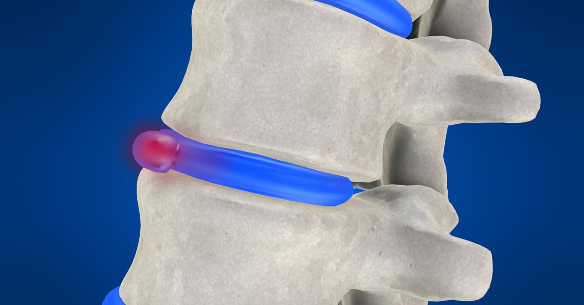 Pinole non-surgical disc herniation treatment