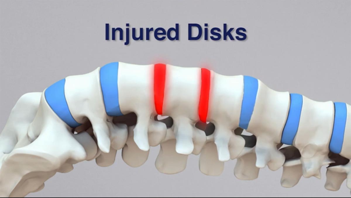 Pinole non-surgical spinal decompression